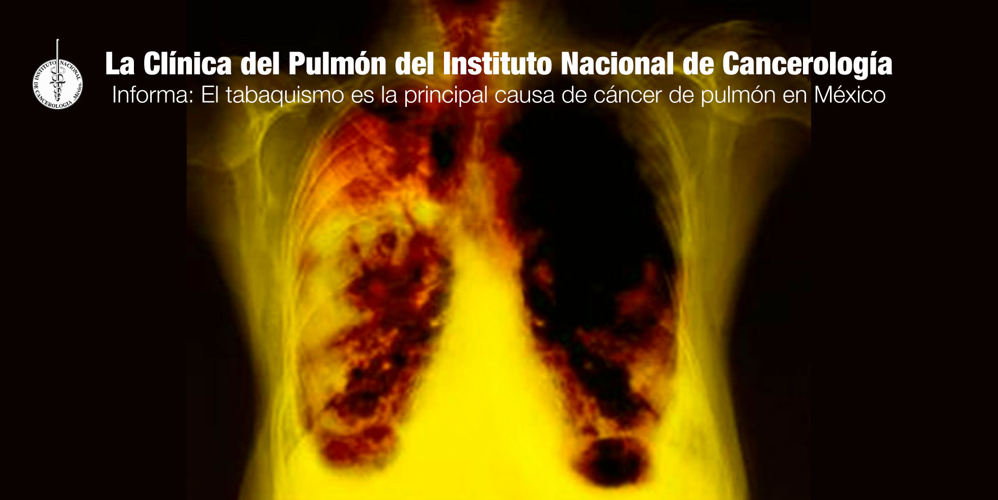 La Clínica del Pulmón del Instituto Nacional de Cancerología informa ...