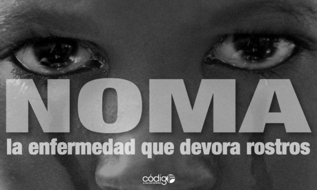 El noma, la enfermedad que devora rostros