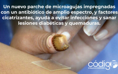 Un nuevo parche de microagujas impregnadas con un antibiótico de amplio espectro, y factores cicatrizantes, ayuda a evitar infecciones y sanar lesiones diabéticas y quemaduras.