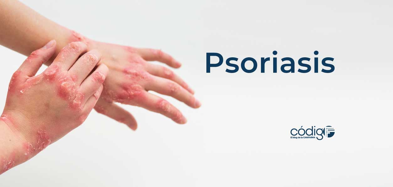 Psoriasis