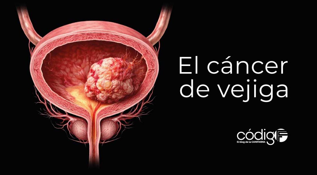 El cáncer de vejiga