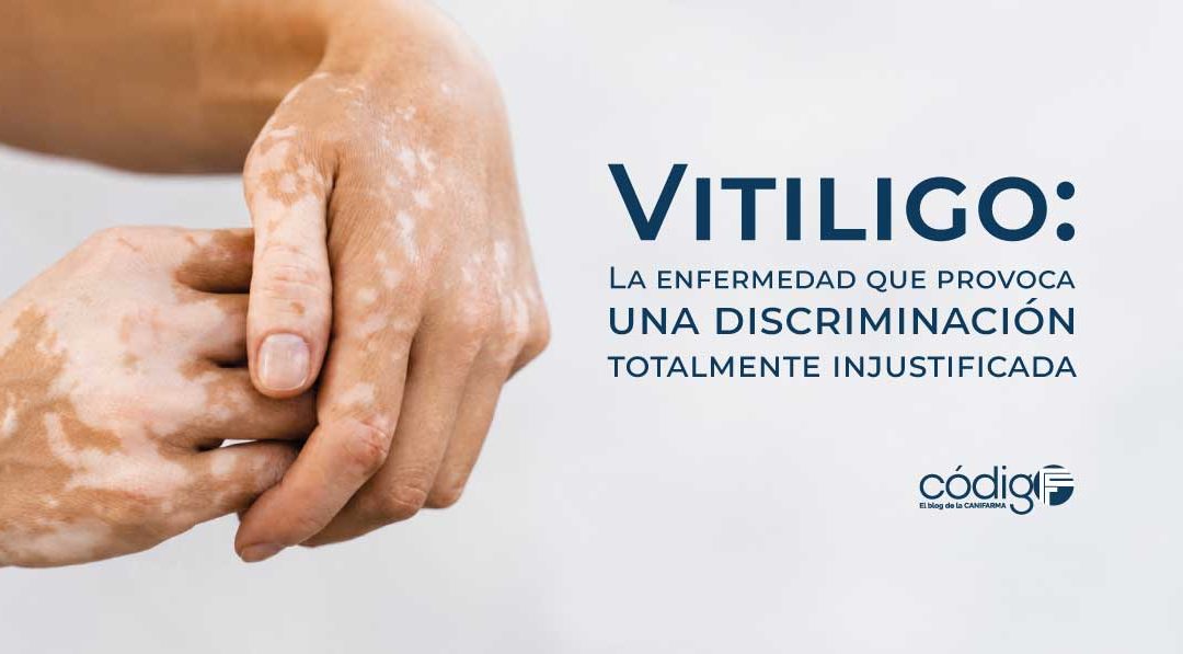 Vitiligo
