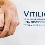 Vitiligo: La enfermedad que provoca una discriminación totalmente injustificada