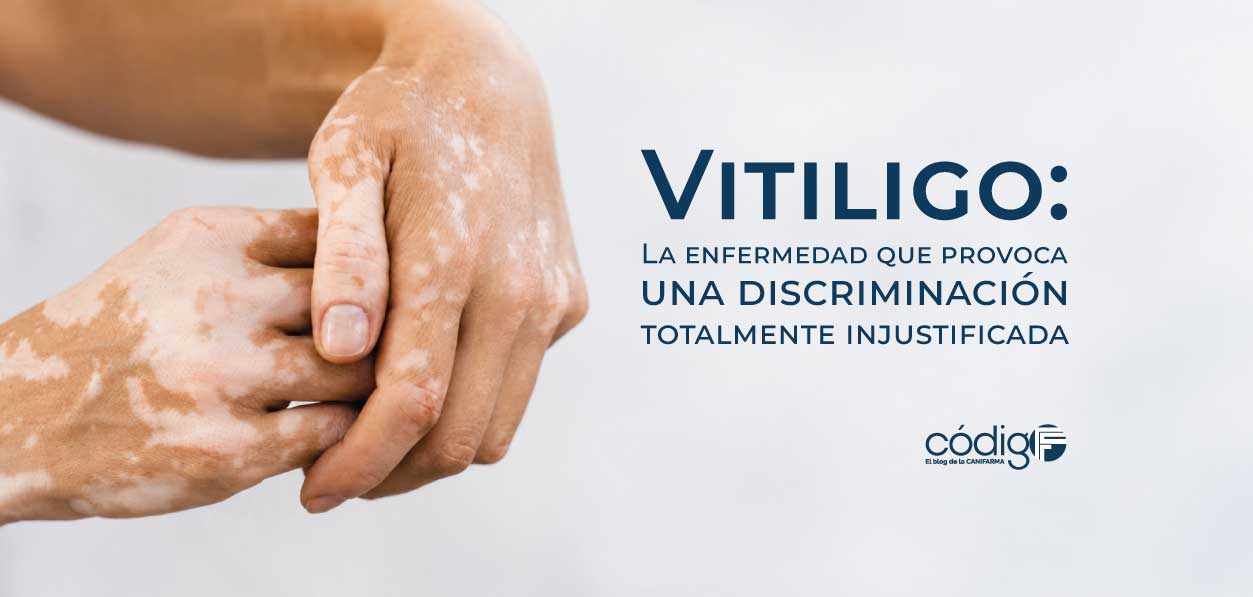 Vitiligo: La enfermedad que provoca una discriminación totalmente injustificada