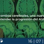 Microtrombos cerebrales, una nueva pista para entender la progresión del Alzheimer