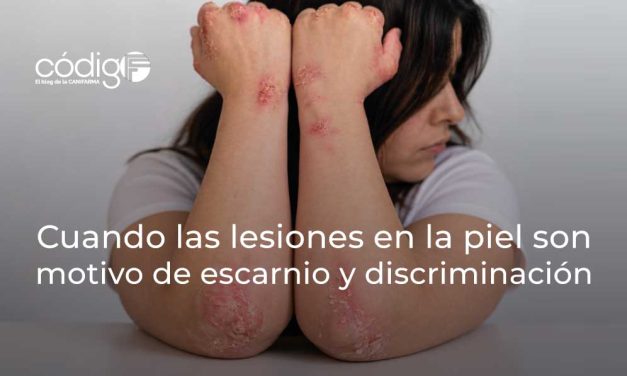 Cuando las lesiones en la piel son motivo de escarnio y discriminación