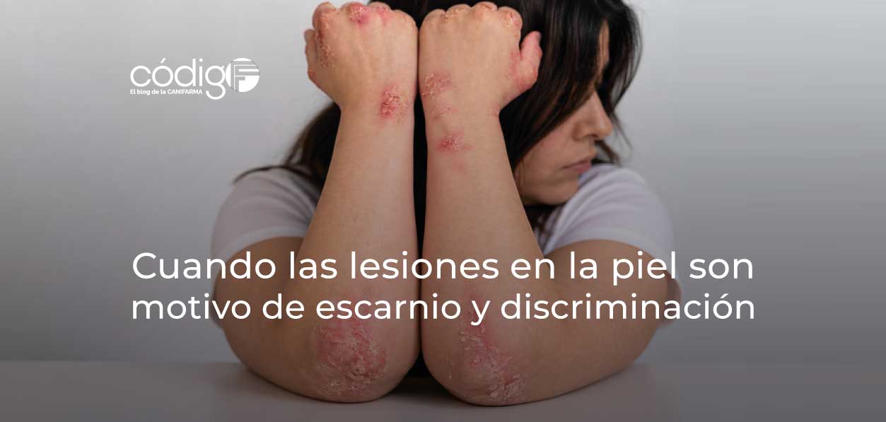 Cuando las lesiones en la piel son motivo de escarnio y discriminación
